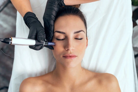 Effective Acne Scar Treatment with Microneedling in Fort Collins