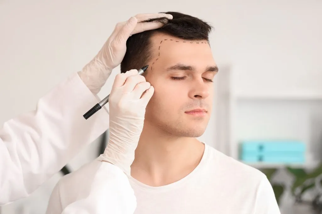 Hair Restoration or Hair Transplant