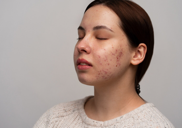 acne treatments